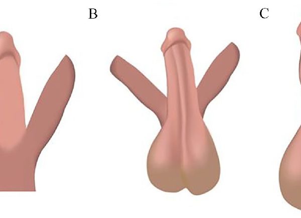 The Essential Guide To Penile Torsion