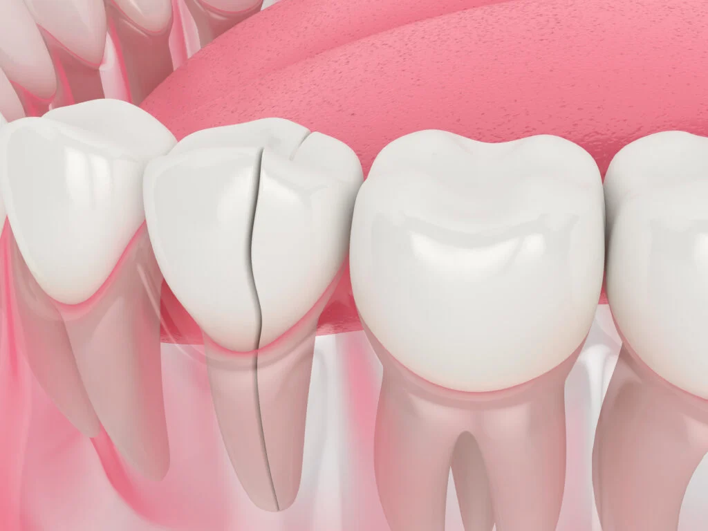 Five Treatment Options for Broken Teeth in Brooklyn, New York