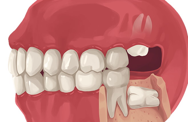 Why Do Wisdom Teeth Need To Be Extracted? 