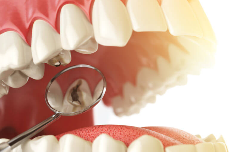 Do You Have Dental Cavities or Tooth Decay? You Should Not Ignore the Signs