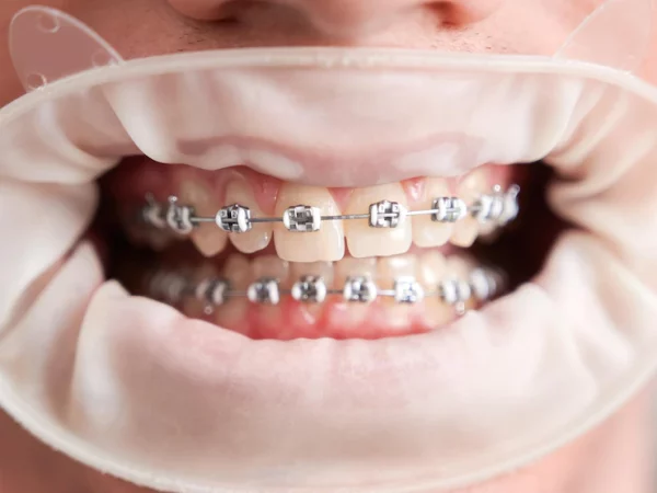 Crafting Confident Smiles by Treating Malocclusion