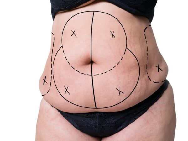 Why is lipo 360 the right choice for you?