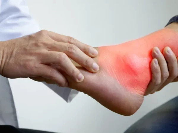 Gout: A Comprehensive Guide to Understanding and Managing the Condition